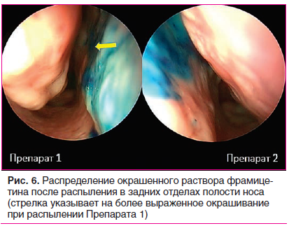 Рис. 6. Распределение окрашенного раствора фрамицетина после распыления в задних отделах полости носа (стрелка указывает на более выраженное окрашивание при распылении Препарата 1)