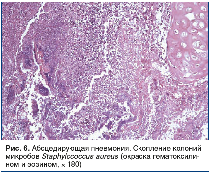 Рис. 6. Абсцедирующая пневмония. Скопление колоний микробов Staphylococcus aureus (окраска гематоксилином и эозином, × 180)