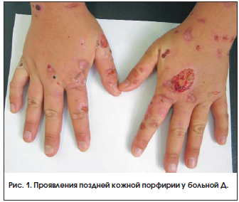 Поздняя кожная порфирия гепатит с thumbnail