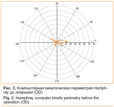 Рис. 2. Компьютерная кинетическая периметрия Humphrey до операции (OD)
