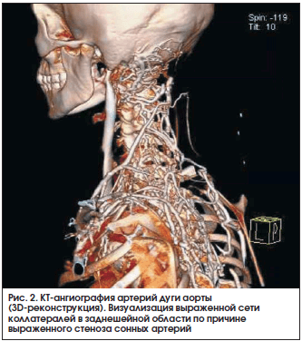 Рис. 2. КТ-ангиография артерий дуги аорты (3D-реконструкция). Визуализация выраженной сети коллатералей в заднешейной области по причине выраженного стеноза сонных артерий