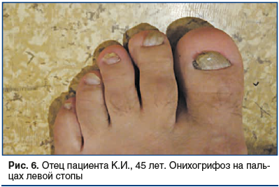 Рис. 6. Отец пациента К.И., 45 лет. Онихогрифоз на пальцах левой стопы