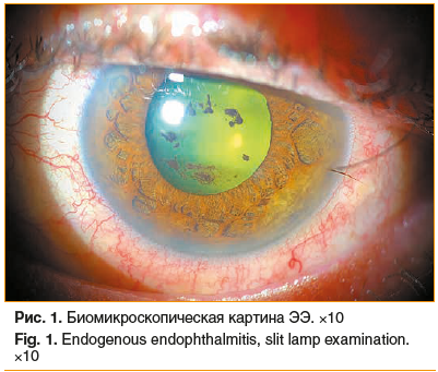 Рис. 1. Биомикроскопическая картина ЭЭ. ×10 Fig. 1. Endogenous endophthalmitis, slit lamp examination. ×10