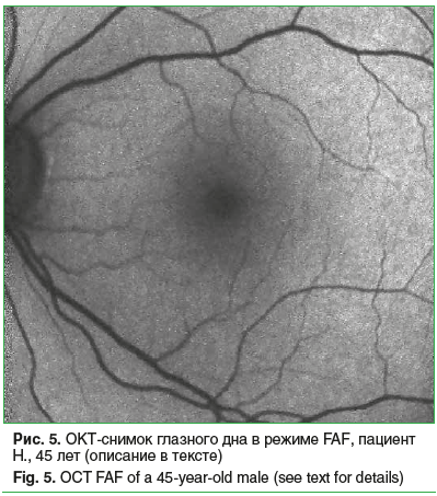 Рис. 5. ОКТ-снимок глазного дна в режиме FAF, пациент Н., 45 лет (описание в тексте) Fig. 5. OCT FAF of a 45-year-old male (see text for details)
