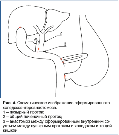 Рис. 4. Схематическое изображение сформированного холедохоэнтероанастомоза.