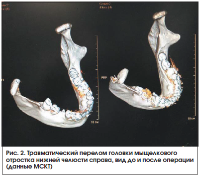 Рис. 2. Травматический перелом головки мыщелкового отростка нижней челюсти справа, вид до и после операции (данные МСКТ)