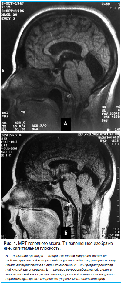 Рис. 1. МРТ головного мозга, Т1-взвешенное изображение, сагиттальная плоскость