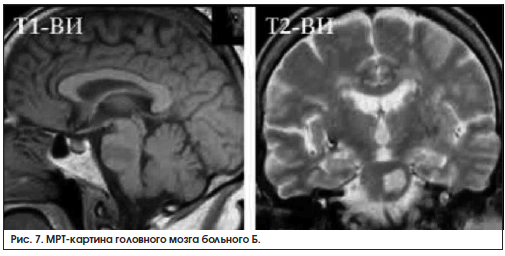 Рис. 7. МРТ-картина головного мозга больного Б.