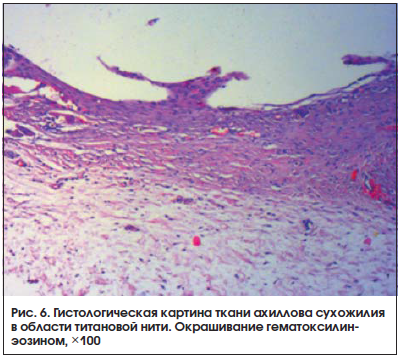 Рис. 6. Гистологическая картина ткани ахиллова сухожилия в области титановой нити. Окрашивание гематоксилинэозином, ×100