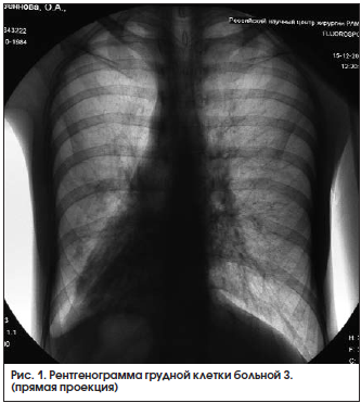 Рис. 1. Рентгенограмма грудной клетки больной З. (прямая проекция)