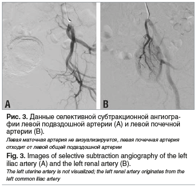 Рис. 3. Данные селективной субтракционной ангиогра- фии левой подвздошной артерии (А) и левой почечной артерии (B). Левая маточная артерия не визуализируется, левая почечная артерия отходит от левой общей подвздошной артерии Fig. 3. Images of selective su