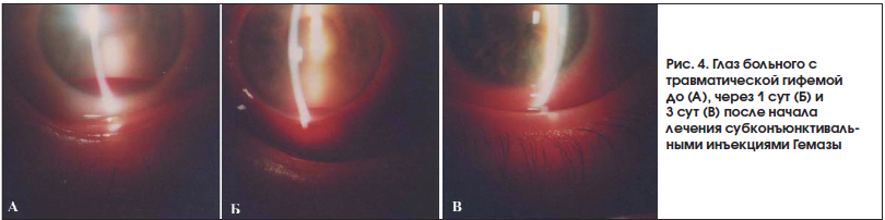 Рис. 4. Глаз больного с травматической гифемой до (А), через 1 сут (Б) и 3 сут (В) после начала лечения субконъюнктивальными инъекциями Гемазы