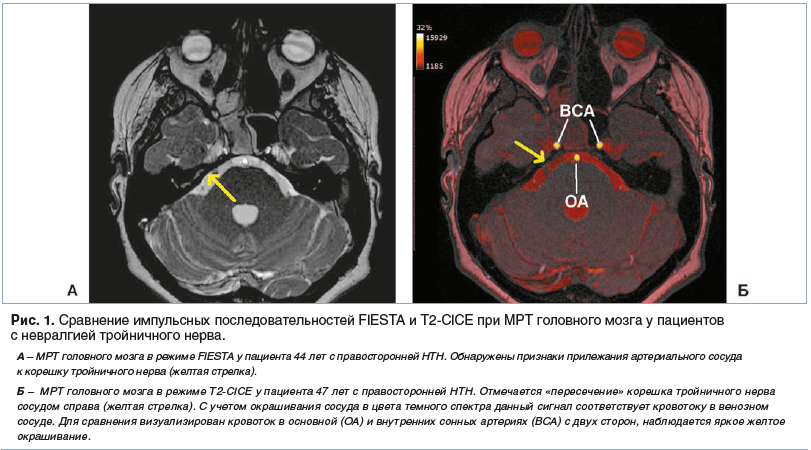 Рис. 1. Сравнение импульсных последовательностей FIESTA и Т2-CICE при МРТ головного мозга у пациентов с невралгией тройничного нерва.