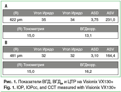 Рис. 1. Показатели ВГД, ВГДрк и ЦТР на Visionix VX130+ Fig. 1. IOP, IOPcc, and CCT measured with Visionix VX130+