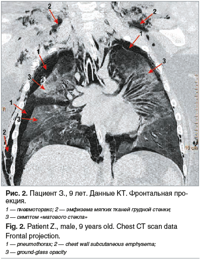 Рис. 2. Пациент З., 9 лет. Данные КТ. Фронтальная про- екция. 1 — пневмоторакс; 2 — эмфизема мягких тканей грудной стенки; 3 — симптом «матового стекла» Fig. 2. Patient Z., male, 9 years old. Chest CT scan data Frontal projection. 1 — pneumothorax; 2 — ch