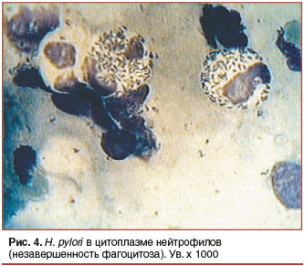 Рис. 4. H. pylori в цитоплазме нейтрофилов (незавершенность фагоцитоза). Ув. х 1000