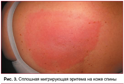 Рис. 3. Сплошная мигрирующая эритема на коже спины