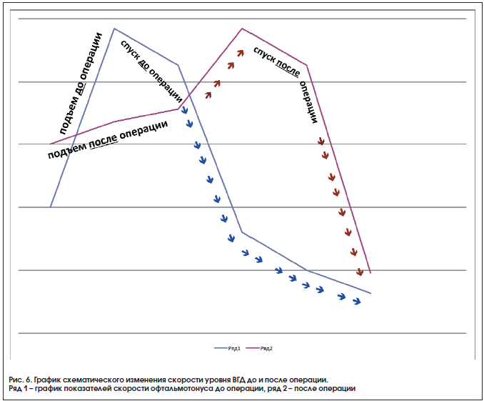 Рис. 6. График схематического изменения скорости уровня ВГД до и после операции