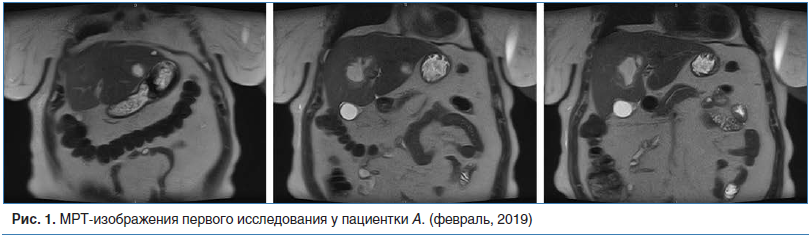 Рис. 1. МРТ-изображения первого исследования у пациентки А. (февраль, 2019)