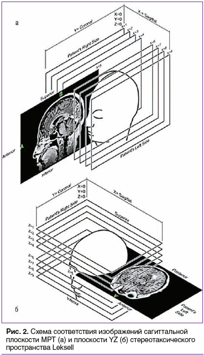Рис. 2. Схема соответствия изображений сагиттальной плоскости МРТ (а) и плоскости YZ (б) стереотаксического пространства Leksell