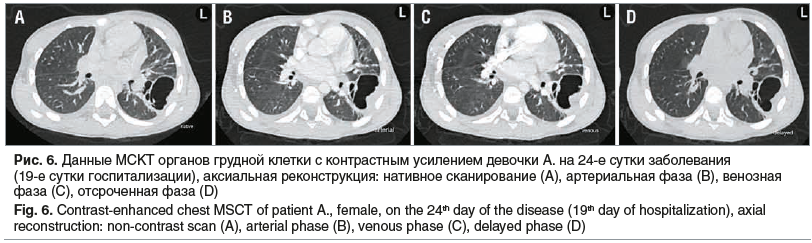 Рис. 6. Данные МСКТ органов грудной клетки с контрастным усилением девочки А. на 24-е сутки заболевания (19-е сутки госпитализации), аксиальная реконструкция: нативное сканирование (А), артериальная фаза (В), венозная фаза (С), отсроченная фаза (D) Fig. 6