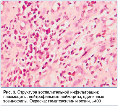 Рис. 3. Структура воспалительной инфильтрации: плазмоциты, нейтрофильные лейкоциты, единичные эозинофилы. Окраска: гематоксилин и эозин, ×400