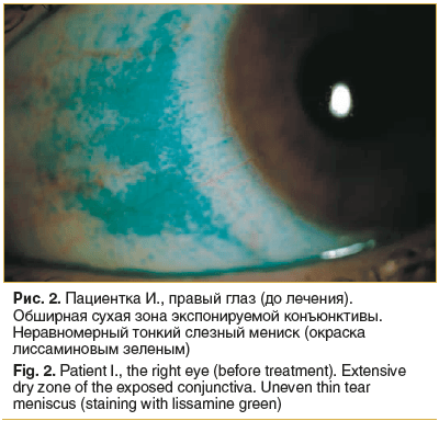 Рис. 2. Пациентка И., правый глаз (до лечения). Обширная сухая зона экспонируемой конъюнктивы. Неравномерный тонкий слезный мениск (окраска лиссаминовым зеленым)