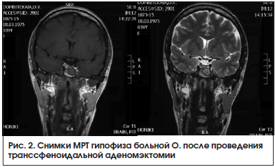 Рис. 2. Снимки МРТ гипофиза больной О. после проведения транссфеноидальной аденомэктомии
