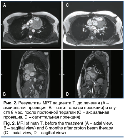 Рис. 2. Результаты МРТ пациента Т. до лечения (А – аксиальная проекция, В – сагиттальная проекция) и спустя 8 мес. после протонной терапии (C – аксиальная проекция, D – сагиттальная проекция) Fig. 2. MRI of man T. before the treatment (A – axial view, B –