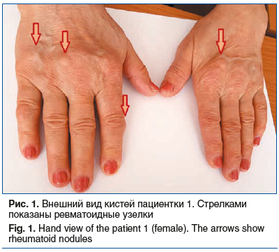 Рис. 1. Внешний вид кистей пациентки 1. Стрелками показаны ревматоидные узелки Fig. 1. Hand view of the patient 1 (female). The arrows show rheumatoid nodules