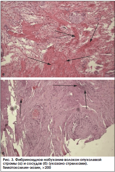 Рис. 3. Фибриноидное набухание волокон опухолевой стромы (а) и сосудов (б) (указано стрелками). Гематоксилин-эозин, ×200