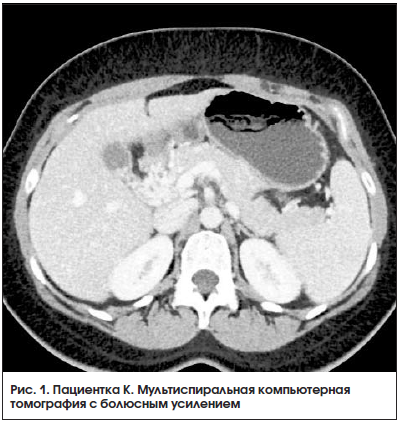 Рис. 1. Пациентка К. Мультиспиральная компьютерная томография с болюсным усилением