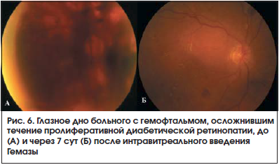 Рис. 6. Глазное дно больного с гемофтальмом, осложнившим течение пролиферативной диабетической ретинопатии, до (А) и через 7 сут (Б) после интравитреального введения Гемазы