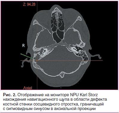 Рис. 2. Отображение на мониторе NPU Karl Storz нахождения навигационного щупа в области дефекта костной стенки сосцевидного отростка, граничащей с сигмовидным синусом в аксиальной проекции