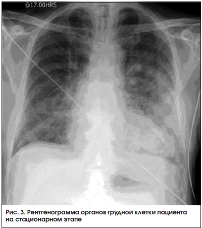 Рис. 3. Рентгенограмма органов грудной клетки пациента на стационарном этапе