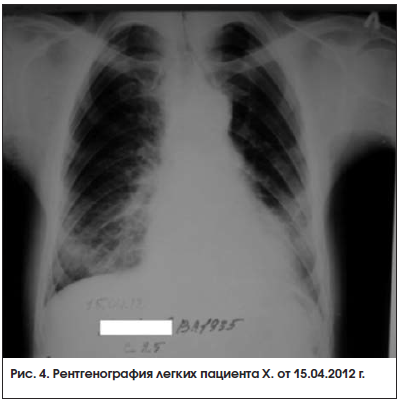 Рис. 4. Рентгенография легких пациента Х. от 15.04.2012 г.
