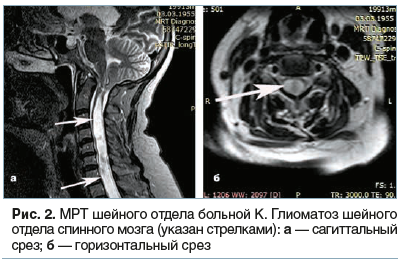 Рис. 2. МРТ шейного отдела больной К. Глиоматоз шейного отдела спинного мозга (указан стрелками): а — сагиттальный срез; б — горизонтальный срез