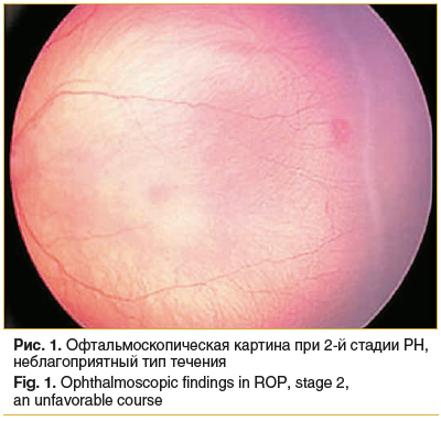 Рис. 1. Офтальмоскопическая картина при 2-й стадии РН, неблагоприятный тип течения Fig. 1. Ophthalmoscopic findings in ROP, stage 2, an unfavorable course