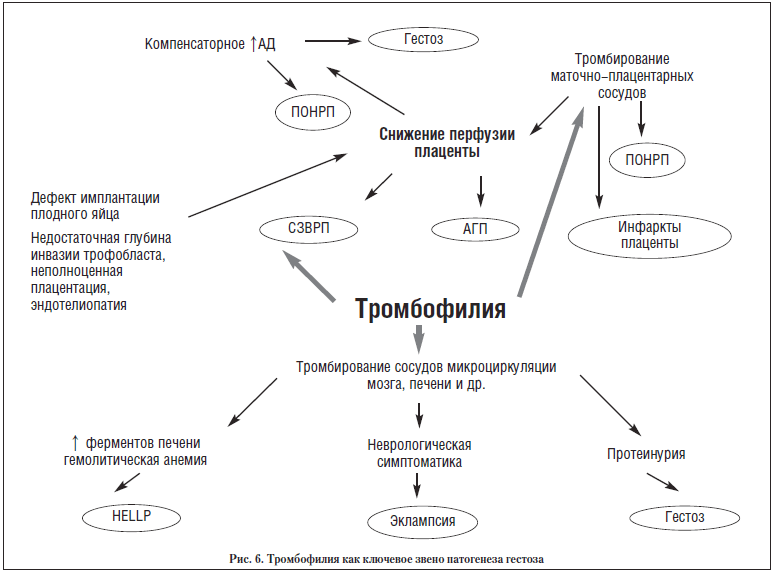 Рис. 6. Тромбофилия как ключевое звено патогенеза гестоза