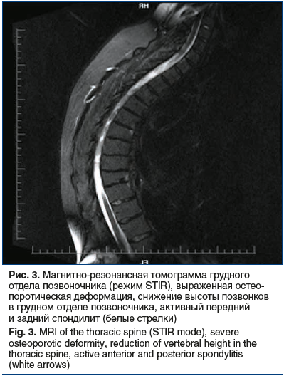 Рис. 3. Магнитно-резонансная томограмма грудного отдела позвоночника (режим STIR), выраженная остео- поротическая деформация, снижение высоты позвонков в грудном отделе позвоночника, активный передний и задний спондилит (белые стрелки) Fig. 3. MRI of the 