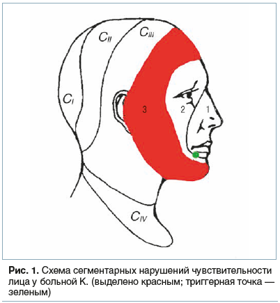 Рис. 1. Схема сегментарных нарушений чувствительности лица у больной К. (выделено красным; триггерная точка — зеленым)