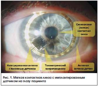 Рис. 1. Мягкая контактная линза с имплантированным датчиком на глазу пациента