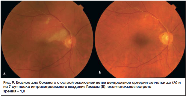 Рис. 9. Глазное дно больного с острой окклюзией ветви центральной артерии сетчатки до (А) и на 7 сут после интравитреального введения Гемазы (Б), окончательная острота зрения – 1,0