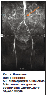 Рис. 4. Нативная (без контраста) МР-ангиография. Снижение МР-сигнала на уровне воспаления дистального отдела аорты