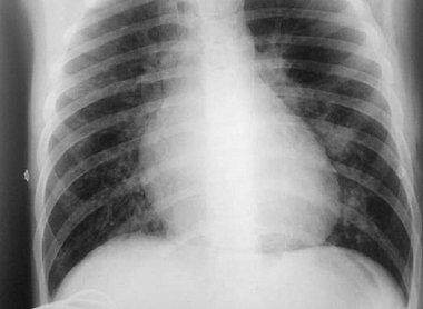 Внебольничная пневмония у подростка с впервые выявленными бронхоэктазами