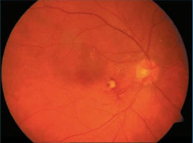 Предикторы формирования сосудистой ретинальной патологии у женщин после преэклампсии