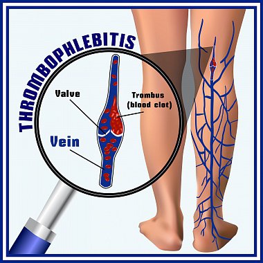 Современные аспекты лечения пациентов с острым тромбофлебитом поверхностных вен нижних конечностей
