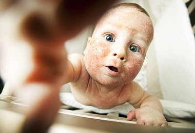 Современный взгляд на базовый уход за кожей детей при атопическом дерматите