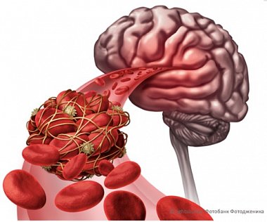 Тромбэктомия при инсульте головного мозга